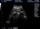 Ultrasound Pics